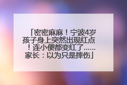 密密麻麻！宁波4岁孩子身上突然出现红点！连小便都变红了……家长：以为只是摔伤